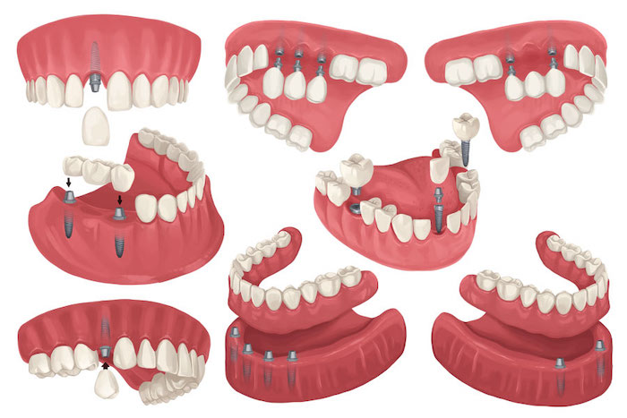 Illustration of various configurations of dental implants to replace missing teeth