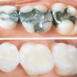 Comparison of teeth with silver amalgam fillings next to teeth with tooth-colored composite resin fillings
