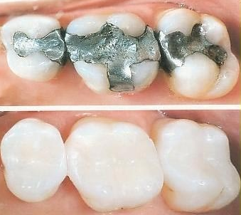 Comparison of teeth with silver amalgam fillings next to teeth with tooth-colored composite resin fillings