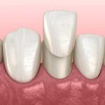 dental veneers, cosmetic dentistry