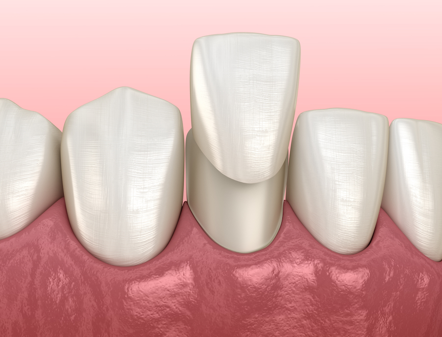 dental veneers, cosmetic dentistry