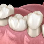 dental crowns, benefits of dental crowns, crown care and maintenance, Elyson Family Dental, Katy TX, tooth restoration, oral health, custom-made dental crowns, dental aesthetics
