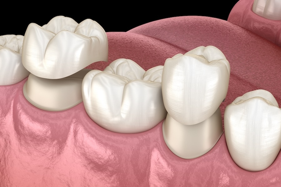 dental crowns, benefits of dental crowns, crown care and maintenance, Elyson Family Dental, Katy TX, tooth restoration, oral health, custom-made dental crowns, dental aesthetics